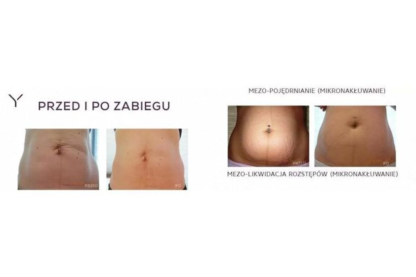Mezoterapia igłowa przed i po - 685180