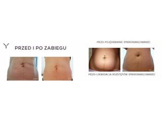 Mezoterapia - przed i po