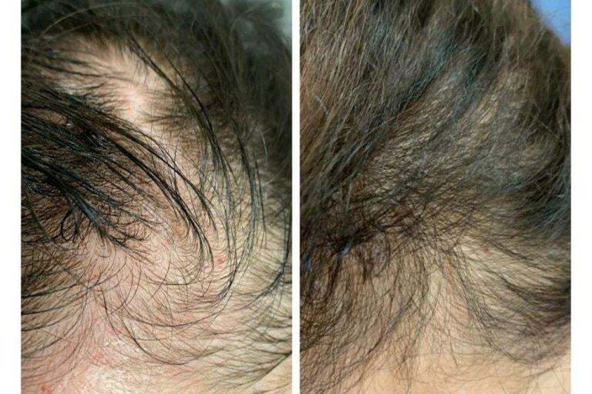 Mezoterapia igłowa przed i po - 788544