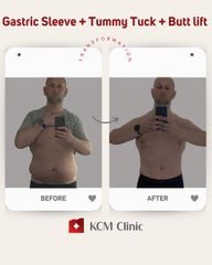 GASTRIC SLEEVE TRANSFORMATION + tummy tuck + butt lift - dr n. med. Grzegorz Kowalski