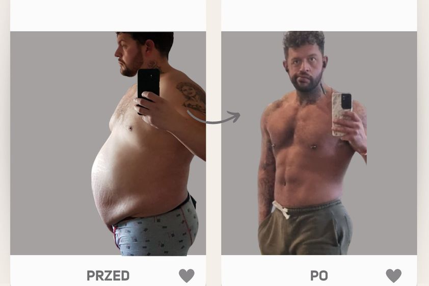 Zmniejszenie żołądka przed i po - 849557