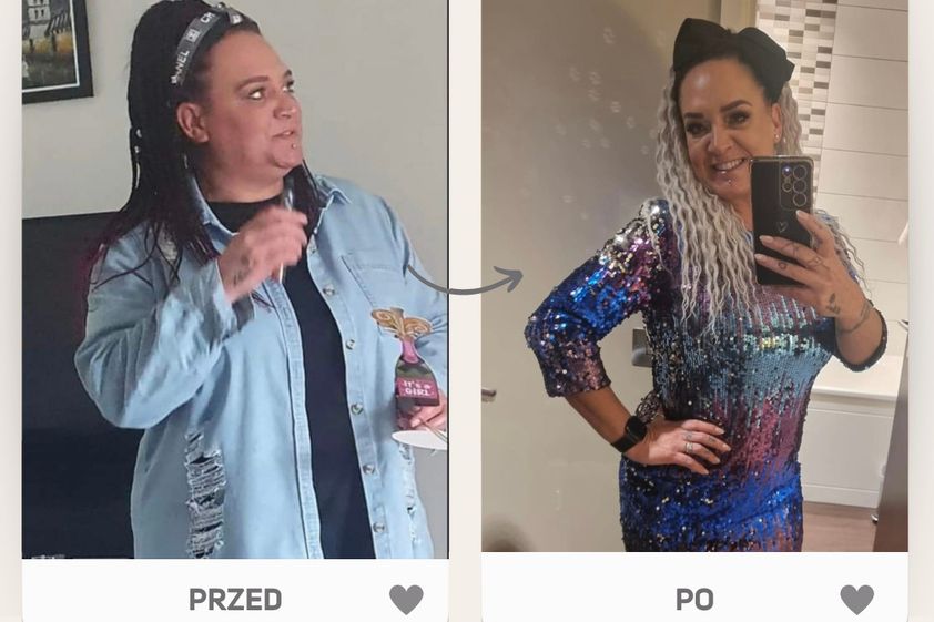 Zmniejszenie żołądka przed i po - 849560