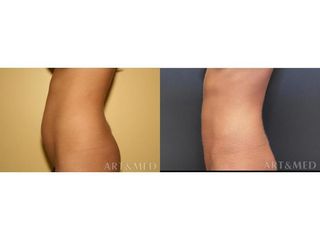 Abdominoplastyka - przed i po