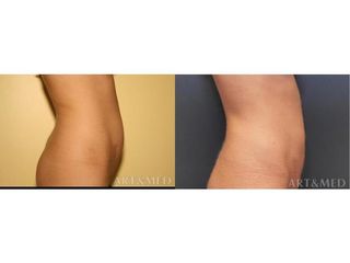 Abdominoplastyka - przed i po