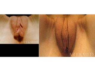 Labioplastyka - przed i po