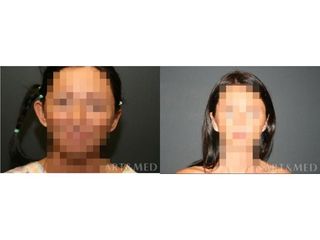Otoplastyka - przed i po