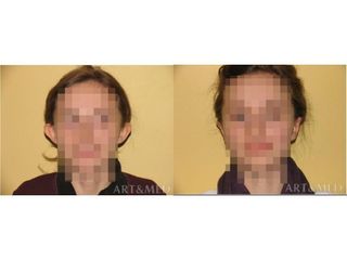 Otoplastyka - przed i po