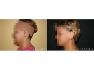 Otoplastyka - przed i po