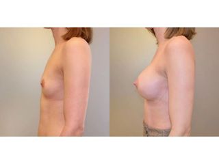 Powiększanie piersi implantami - przed i po