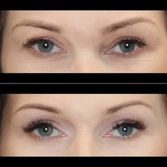 Blefaroplastyka - Dr Michał Charytonowicz