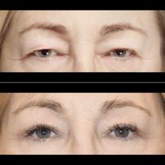 Blefaroplastyka - Dr Michał Charytonowicz