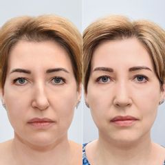 korekcja nosa