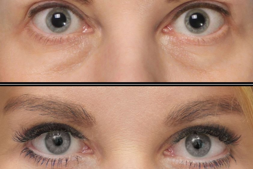 Blefaroplastyka przed i po - 880019