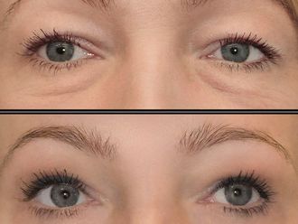 Blefaroplastyka przed i po - 880020