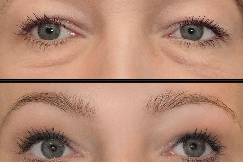 Blefaroplastyka przed i po - 880020
