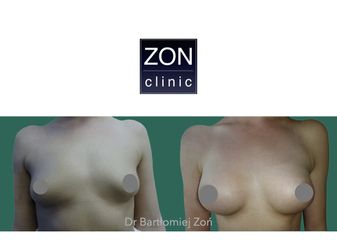 Powiększanie biustu - dr Bartłomiej Zoń