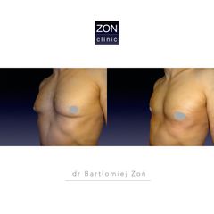 Ginekomastia - dr Bartłomiej Zoń
