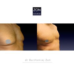 Ginekomastia - dr Bartłomiej Zoń