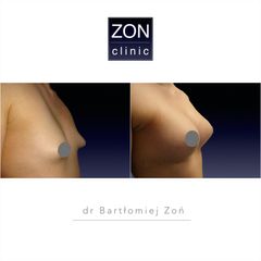 Powiększanie biustu - dr Bartłomiej Zoń
