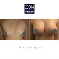 Powiększanie biustu - dr Bartłomiej Zoń
