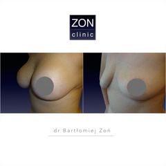 Zmniejszenie biustu - dr Bartłomiej Zoń