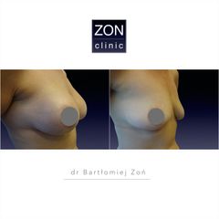 Zmniejszenie biustu - dr Bartłomiej Zoń