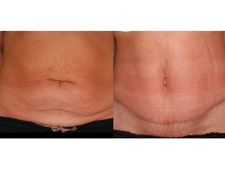 Abdominoplastyka - przed i po