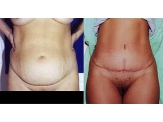 Abdominoplastyka - przed i po