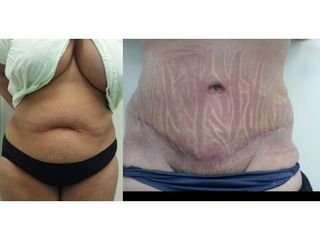 Abdominoplastyka z liposukcją - przed i po
