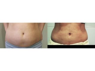 Liposukcja laserowa - przed i po