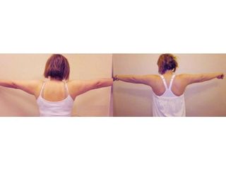 Liposukcja ramion - przed i po