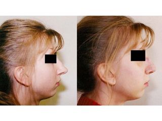 Operacja plastyczna nosa - przed i po