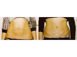 Abdominoplastyka - przed i po