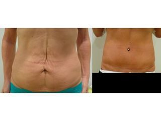 Liposukcja i plastyka brzucha - przed i po