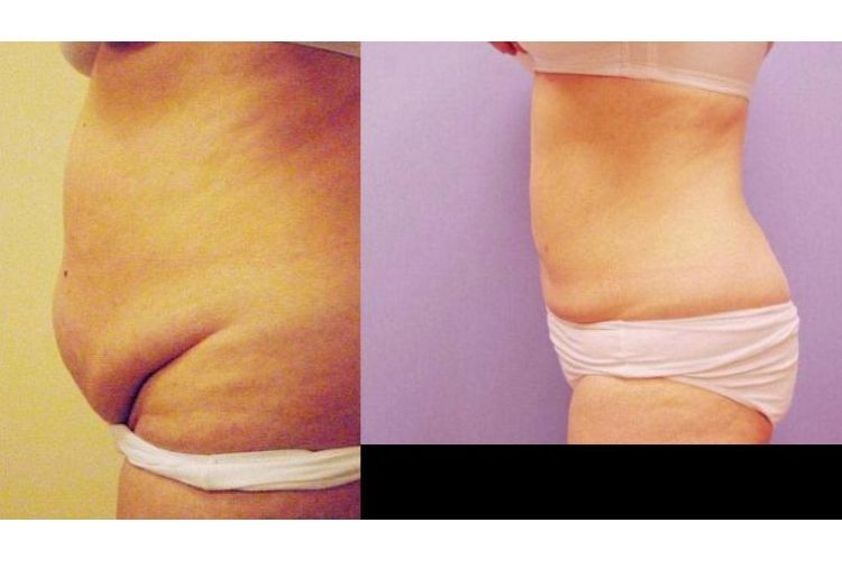 Liposukcja laserowa przed i po - 687586