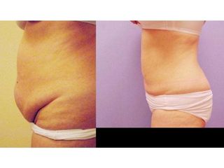 Liposukcja laserowa - przed i po