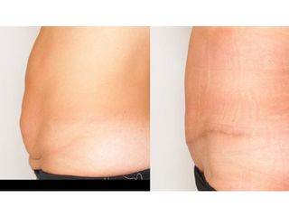 Abdominoplastyka - przed i po