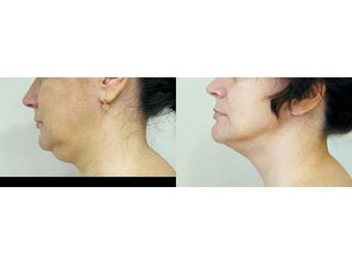 Liposukcja podbródka - przed i po