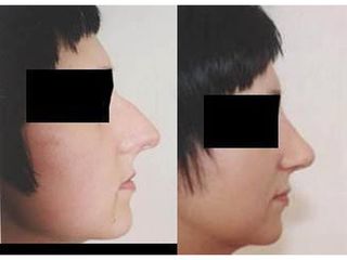 Operacja plastyczna nosa - przed i po