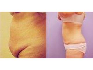Abdominoplastyka - przed i po