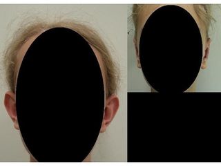 Korekcja uszu - przed i po