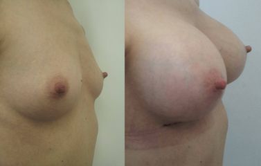 Powiększanie piersi - przed i po