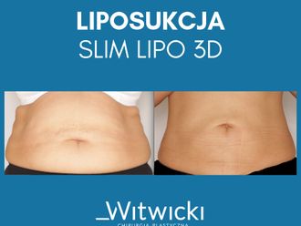 Liposukcja laserowa przed i po - 741147