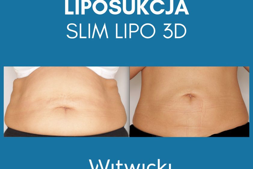 Liposukcja laserowa przed i po - 741147