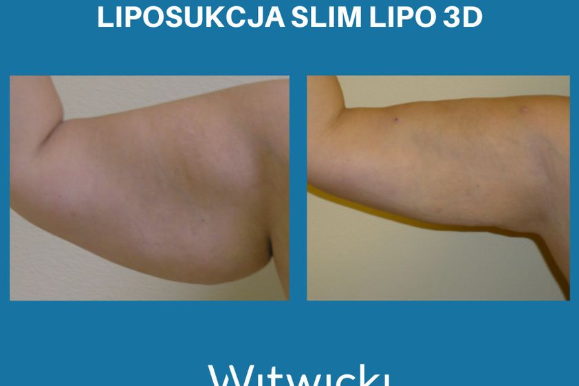 Liposukcja laserowa przed i po - 741148