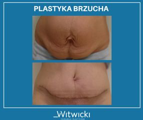 plastyka_brzucha