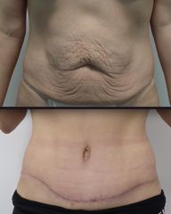 Abdominoplastyka - Dr n. med. Tadeusz Witwicki