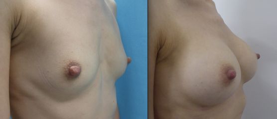 Powiększenie piersi implantami - Dr n. med. Tadeusz Witwicki