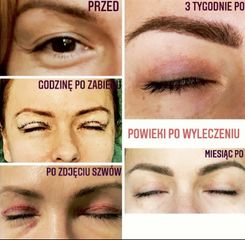 Blefaroplastyka - Dr Ziajka Klinika Chirurgii Estetycznej