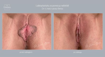 Dr n. med. Łukasz Bełza - Labioplastyka